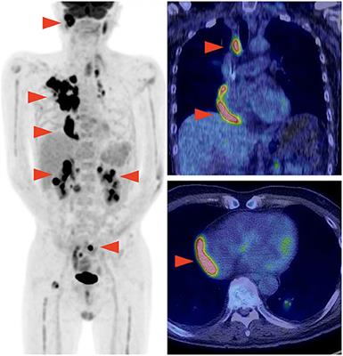 Case Report: Cardiac Tamponade in Association With Cytokine Release Syndrome Following CAR-T Cell Therapy